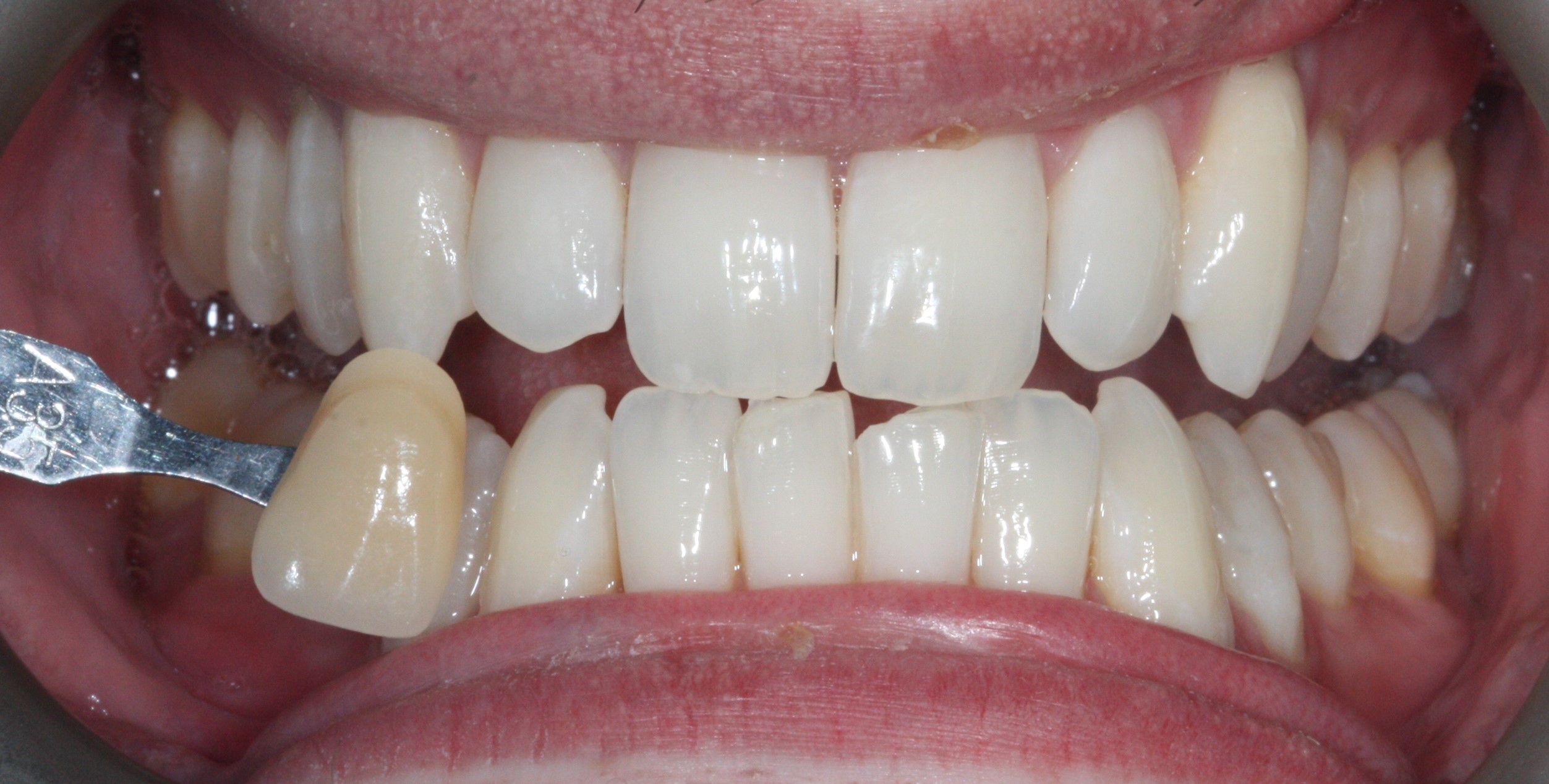 1 Teeth whitening After