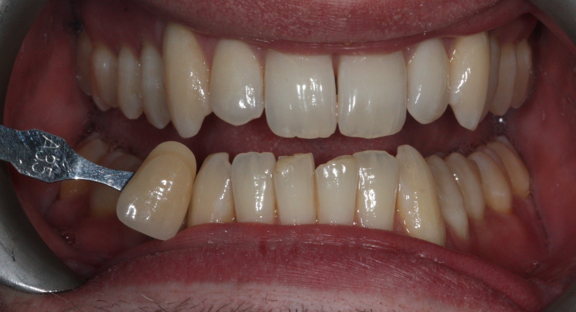 1 Teeth whitening Before