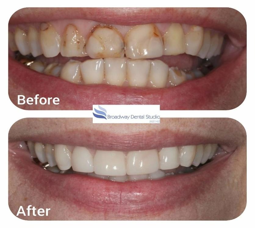 Teeth Whitening
